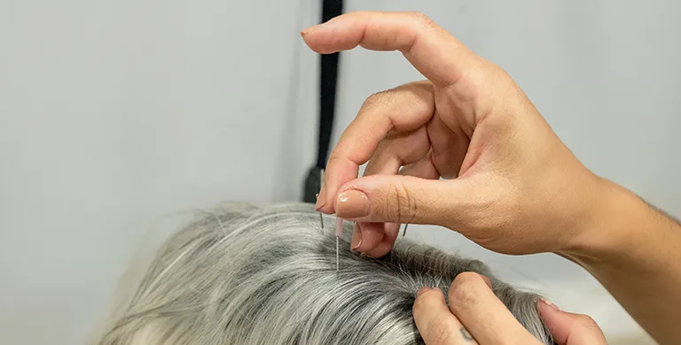 ACUPUNTURA